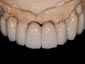 Full arch in zirconio ceramizzato