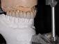 Full arch in zirconio ceramizzato