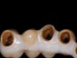 Cappe auro-galva incollate al full arch in zirconio