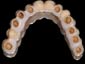 Cappe auro-galva incollate al full arch in zirconio