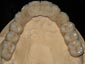 Full arch in zirconio terminato